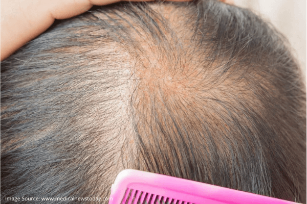 Managing Hair Loss with Hair Transplant