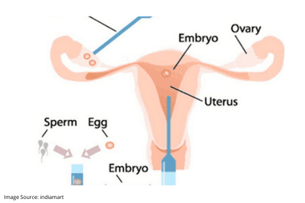 Success Rates of IVF Treatment