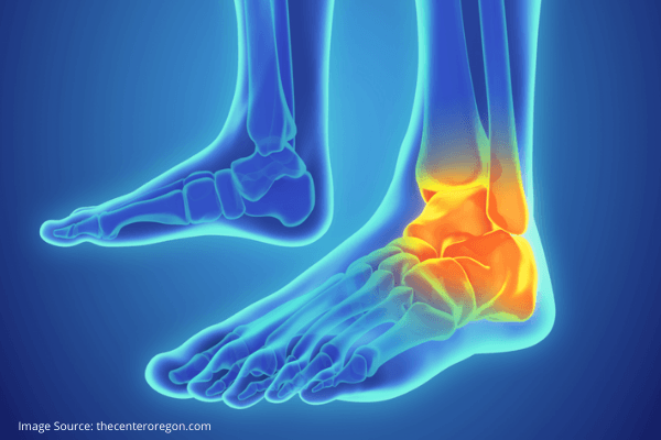 First Aid for Sprained Ankles
