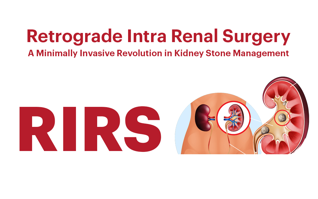 RIRS (Retrograde Intra Renal Surgery): A Minimally Invasive Revolution in Kidney Stone Management