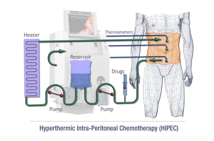 What is HIPEC?
